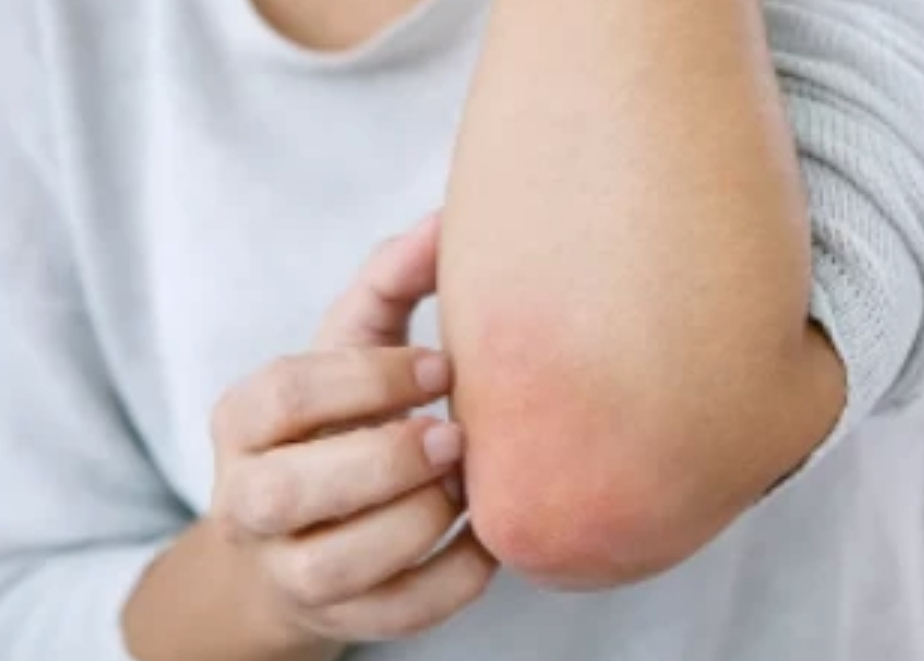 科普｜春季过敏皮肤病高发 专家提醒：青少年特应性皮炎需引起重视